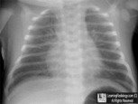 transient tachypnea of the newborn ttn